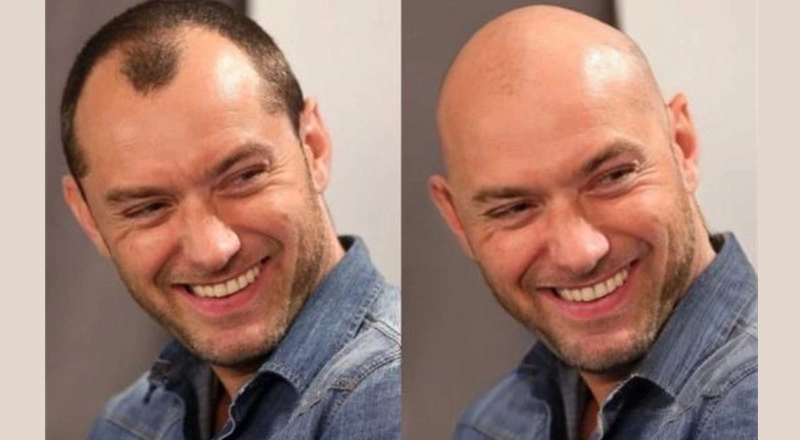 Veja Como Fica Careca Com 4 Filtros Careca De IA